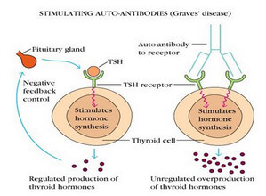 Grave Disease An Autoimmune Disease