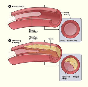 Narrowing of arteries in atherosclerosis image