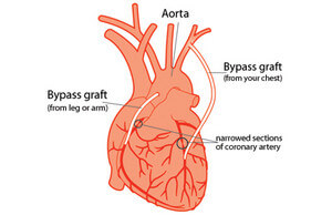 Coronary bypass surgery picture