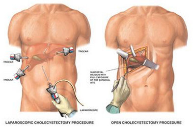 Open cholecystectomy vs. laparoscopic cholecystectomy picture