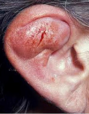 ear affected by perichondritis picture