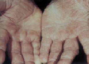 Hand Fungus – Symptoms, Causes, Pictures and Treatment