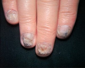 Hand Fungus – Symptoms, Causes, Pictures and Treatment