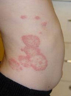 Fungal Rash – Symptoms, Causes (Risk Factors), Pictures, Treatment ...