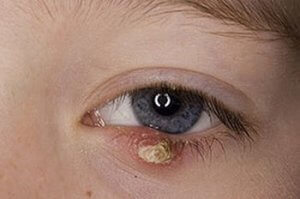 eyelid folliculitis