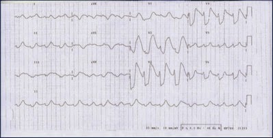 ECG shows hyperkalemia in its late state image