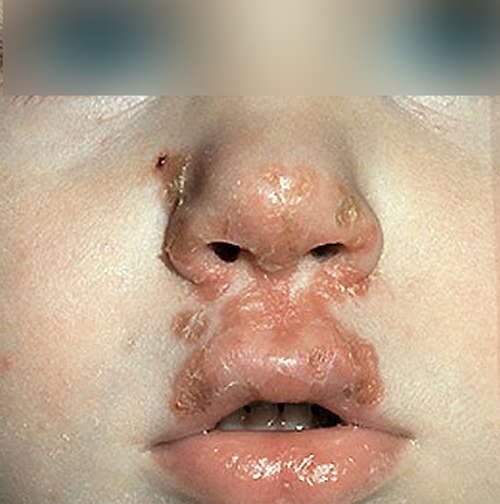 A non-bullous type of infantigo; lesions-sores around the child’s mouth and nose image photo picture