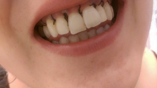 Dissolvable stitches are commonly used by dentist in performing oral surgery image photo picture
